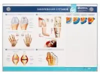 310_МУ0073_Стенд_Заболевания_суставов
