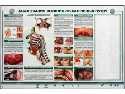 Интерактивный электрифицированный стенд "Заболевания верхних дыхательных путей" с натурным образцом
